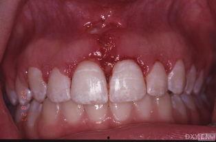 成人牙床图片大全视频,揭秘牙齿排列与口腔健康