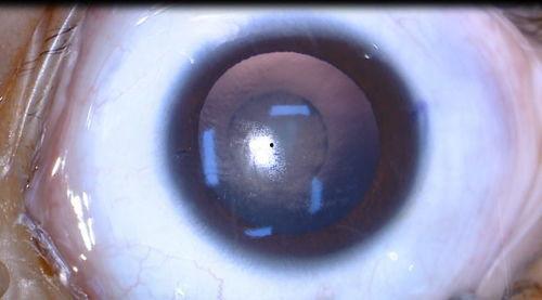 成人散光可以矫正吗视频,揭秘视力恢复之路